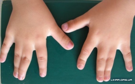 Перепонки между пальцами у мужчин. Костная форма синдактилии. Синдактилия перепончатая форма.