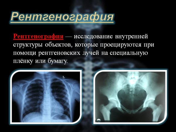 Ленинградский рентген на дому СПб 

РЕНТГЕН НА ДОМУ, УЗИ, ЭКГ, хирург + перевязки на дому, постановка мочевых катетеров; - в городе С.Петербург и Ленинградская области при переломе шейки бедра и пневмонии Рентген на дому СПб: по вашему адресу приезжает врач-рентгенолог, травматолог-ортопед с мобильным рентгеновским аппаратом, проводит диагностику травмы или заболевания, делает необходимые рентгенограммы, проявляет их на месте, дает рекомендации по дальнейшему лечению. 
УЗИ, ЭКГ, хирург + перевязки на дому, постановка мочевых катетеров
Препарат показывал феноменальные результаты экспериментов. В 1953 году Дорогов, униженный тем, что ему не разрешают заявить о своем открытии во всеуслышание, написал письмо тогдашнему наркому здравоохранения СССР Андрею Третьякову. В нем он предлагал обучить тысячи врачей тканевой терапии в специальной клинике в Москве, откуда те могли бы разъехаться по Союзу. 
Третьяков ответил отказом. Против врача тут же началось прокурорское преследование. Его обвинили в незаконной медицинской деятельности, закрыли возглавляемую им лабораторию, а в 1957 году Дорогов и вовсе скоропостижно скончался. Разумеется, при до конца невыясненных обстоятельствах: говорят, среди бела дня отравился угарным газом во дворе (!) собственного дома! 
14 апреля 1959 года всю информацию касательно АСД Ф-1 засекретили! 
Потом, когда СССР развалился, АСД начали продавать в аптеках. Т.е. он существует, но существует тихо. Он как бы и есть, но для большинства людей его "не существует". Большинство врачей ничего толком о нем и не слышали: АСД-Ф1 не изучают в медицинских университетах. А препараты АСД-Ф2 и АСД-Ф3 (производные от "оригинала") используют исключительно в ветеринарии.
#рентген_в_спб, #рентген_в_петербурге, #рентген_легких, #перелом_шейки_бедра, #шейка_бедра, #сделать_рентген, #сделать_рентген_на_дому, #вызвать_врача, #вызвать_врача_на_дом, #врач_на_дом, #вызвать_травматолога, #травматолог_на_дом, #перелом_ребер, #вправить_вывих, #травматолог, #перелом, #травма #вывих, #флюорография, #флюорография_на_дому, #ушиб, #пневмония 
#рентген_на_дому_спб #рентген_на_дому_Спб 
#рентген_на_дому_шейки_бедра_спб 
#рентген_на_дому_лёгкие_спб 
#рентген_на_дому_позвоночника_спб 
#рентген_на_дому_отзывы_спб 
#сделать_рентген_на_дому_спб 
#вызвать_рентген_на_дом_спб 
#УЗИ_на_дому_СПб 
#ЭКГ_на_дому_СПб